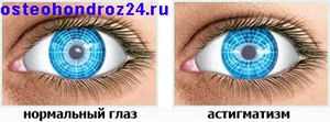 Что такое астигматизм глаз у детей