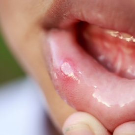 трещины на губах у ребенка чем лечить