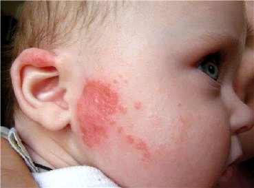 аллергия на мед у ребенка фото