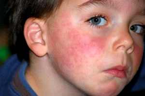 Аллергия на мед у ребенка фото