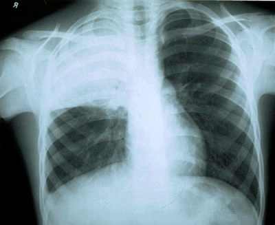 прикорневая пневмония у детей рентген