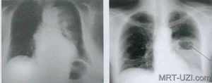 Прикорневая пневмония у детей рентген