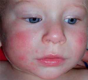 аллергия на овсянку у ребенка симптомы