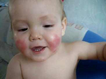 Аллергия у ребенка 6 лет фото