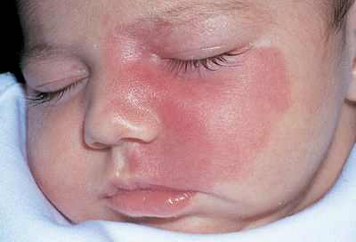 гемангиома у детей на лице