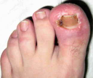 Вросший ноготь на большом пальце ноги: лечение в домашних условиях