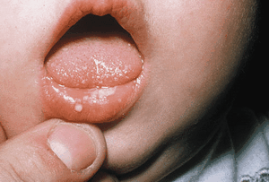 Вирусный стоматит у ребенка лечение