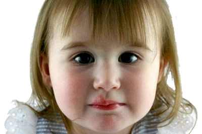 герпес на лице у ребенка чем лечить