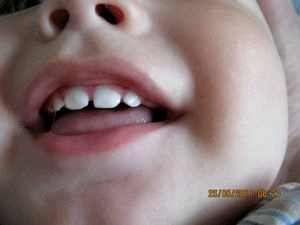 Гипоплазия эмали у ребенка фото
