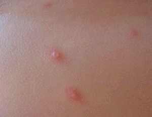 Краснуха у грудных детей комаровский