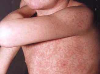 признаки аллергии у детей 3 лет