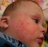 признаки аллергии у детей 3 лет