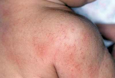 Признаки аллергии у детей 3 лет